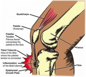 Osgood-schlatter Disease