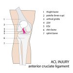 ACL Tear, Do You always Need Surgery? | PhysioNow Mississauga