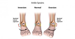 Acute Ankle Sprains - Physionow & Applewood Sports And Physio