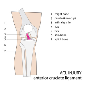 ACL Tear - Physiotherapy in Burlington ON