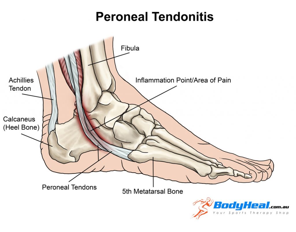 Peroneal tendinopathy, PhysioNow, Mississauga, Physiotherapy